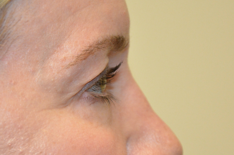 Eyelid-Surgery-09 | Before Eyelid Surgery 5