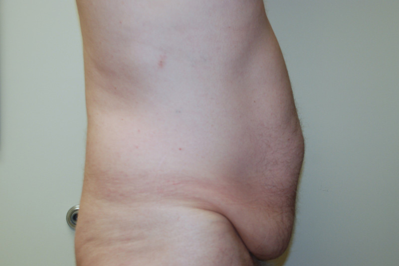 Tummy-Tuck-11 | Before Tummy Tuck 5