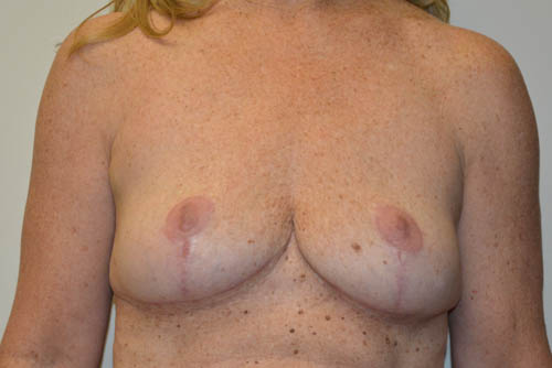 Implant-Removal-07 | After Implant Removal