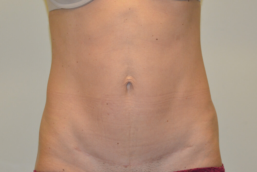 Mini-Tummy-Tuck-08 | After Mini Tummy Tuck 1