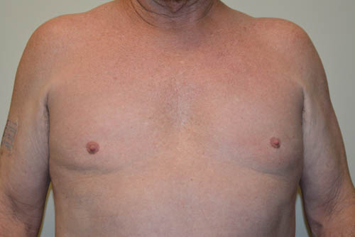 Male-Breast-Reduction-08 | After Male Breast Reduction