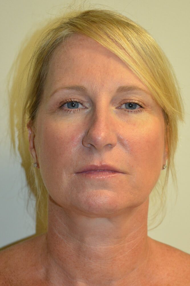 Rhinoplasty-08 | After Rhinoplasty