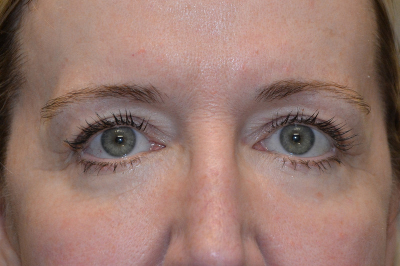 Eyelid-Surgery-09 | After Eyelid Surgery 1