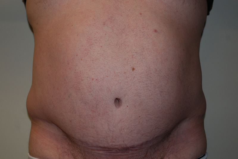 Tummy-Tuck-11 | After Tummy Tuck