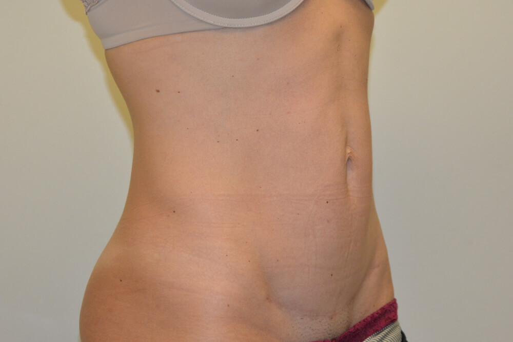 Mini-Tummy-Tuck-08 | After Mini Tummy Tuck 2