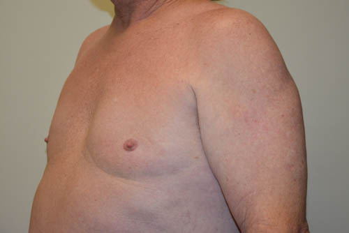 Male-Breast-Reduction-08 | After Male Breast Reduction 4