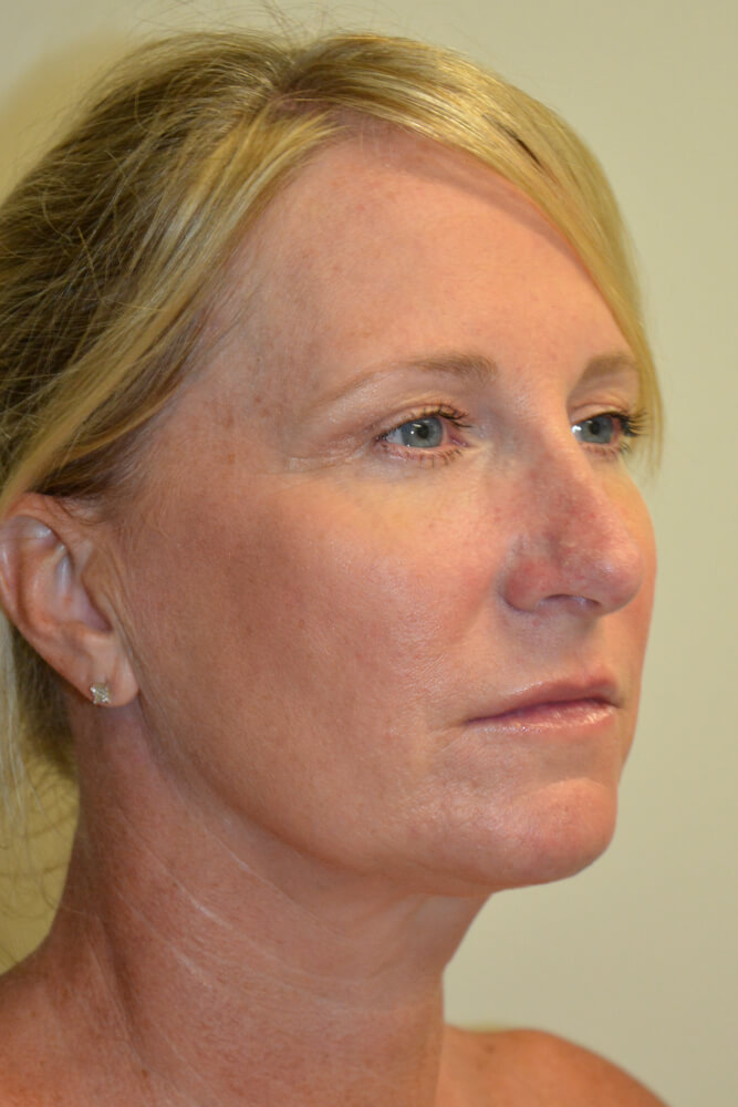 Rhinoplasty-08 | After Rhinoplasty 2