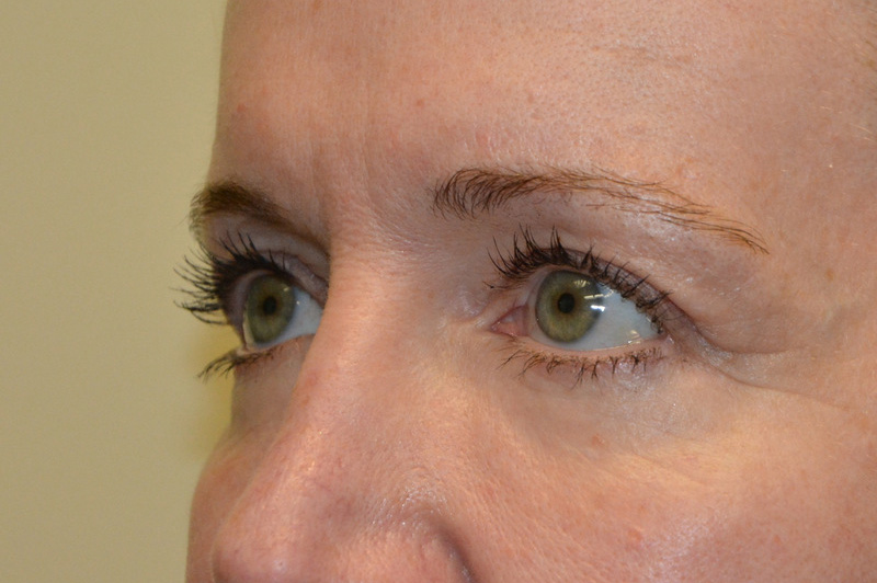 Eyelid-Surgery-09 | After Eyelid Surgery 2