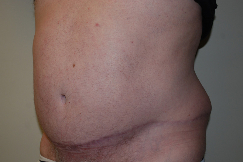 Tummy-Tuck-11 | After Tummy Tuck 2