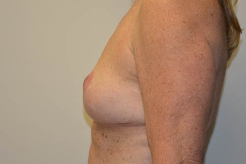 Implant-Removal-07 | After Implant Removal 5