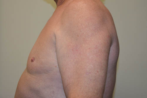 Male-Breast-Reduction-08 | After Male Breast Reduction 5