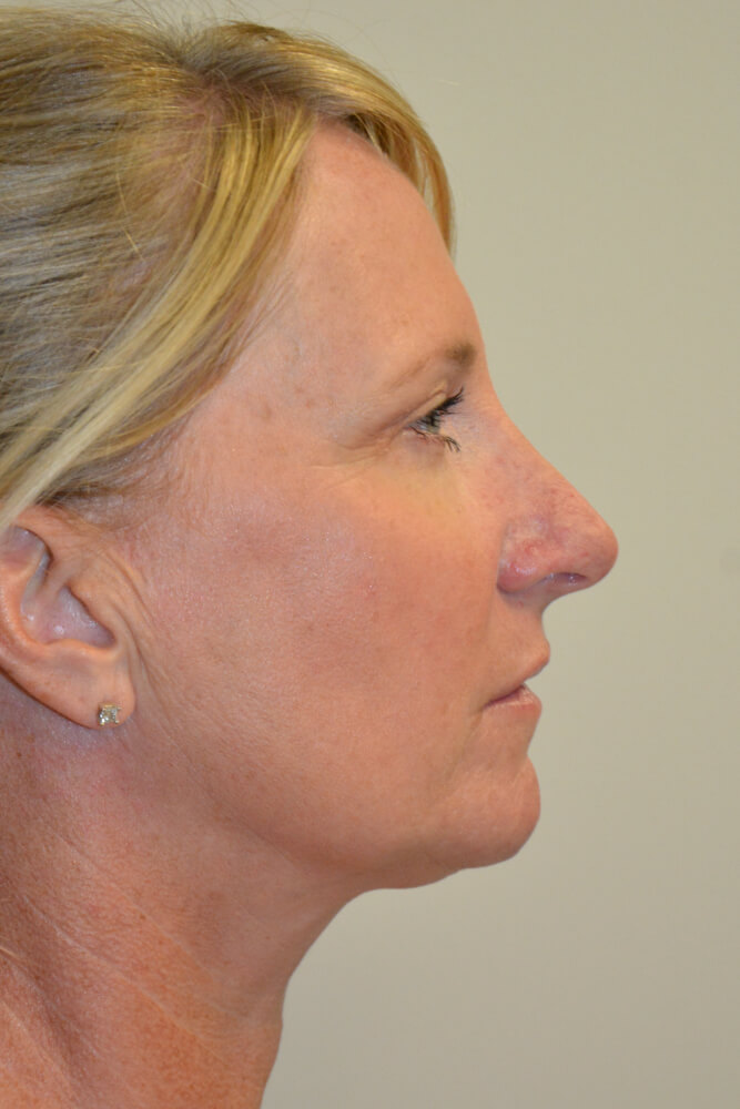 Rhinoplasty-08 | After Rhinoplasty 3