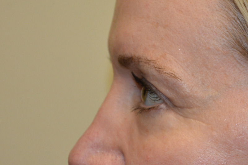 Eyelid-Surgery-09 | After Eyelid Surgery 3