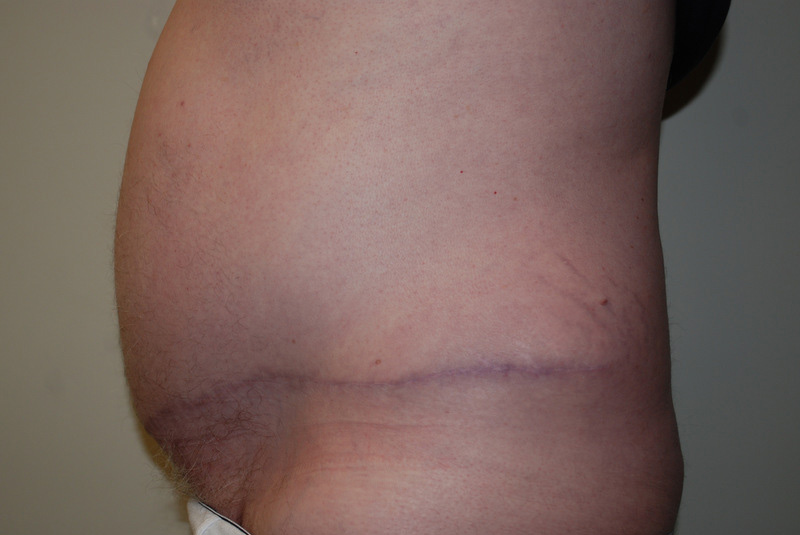 Tummy-Tuck-11 | After Tummy Tuck 3