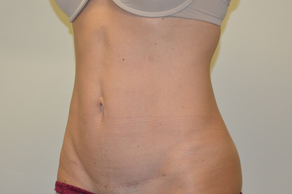 Mini-Tummy-Tuck-08 | After Mini Tummy Tuck 4