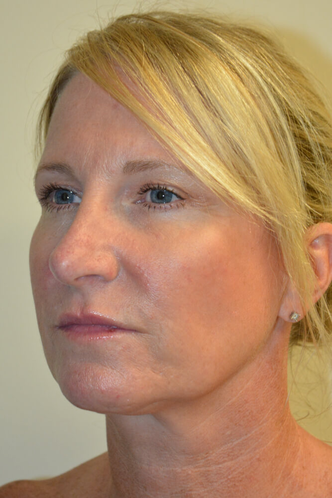 Rhinoplasty-08 | After Rhinoplasty 4