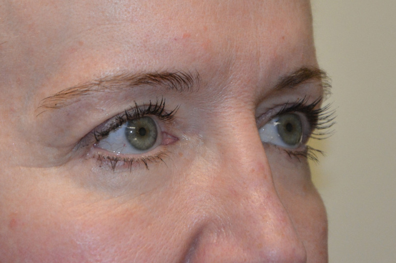 Eyelid-Surgery-09 | After Eyelid Surgery 4