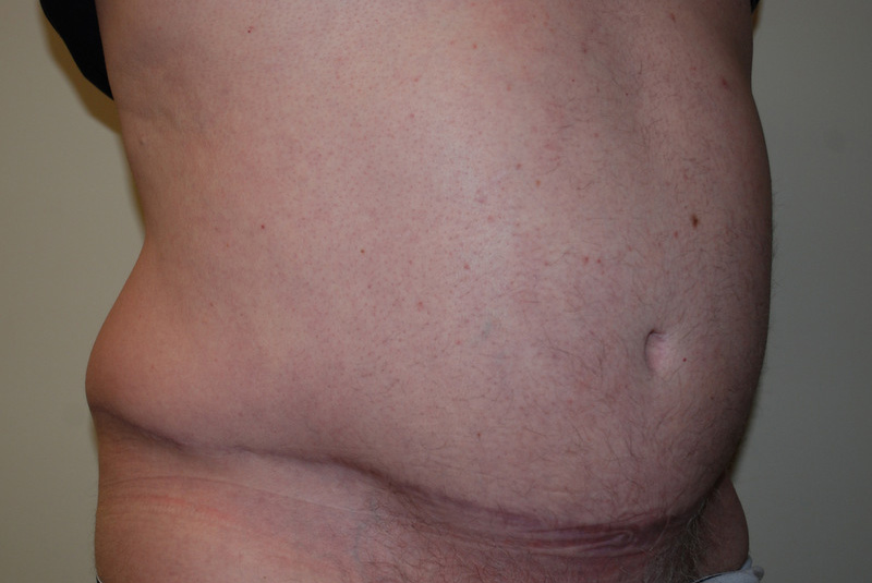 Tummy-Tuck-11 | After Tummy Tuck 4