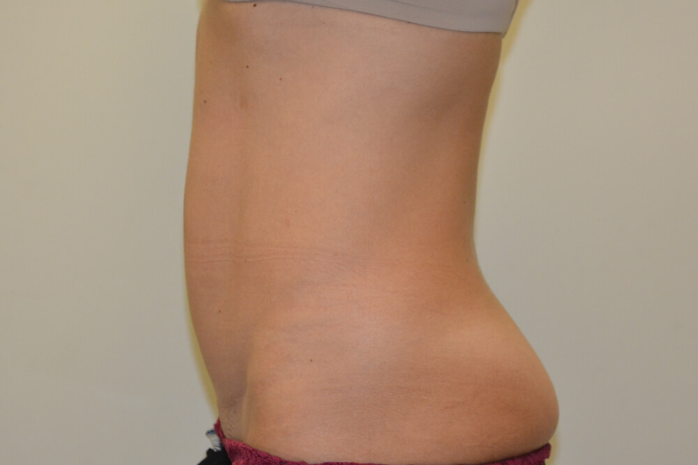 Mini-Tummy-Tuck-08 | After Mini Tummy Tuck 5