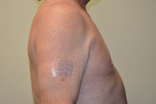 Male-Breast-Reduction-08 | After Male Breast Reduction 3
