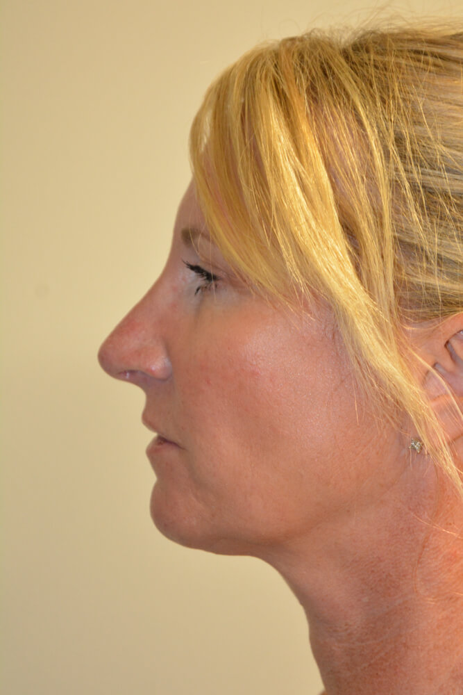 Rhinoplasty-08 | After Rhinoplasty 5