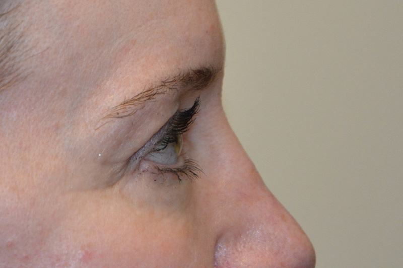Eyelid-Surgery-09 | After Eyelid Surgery 5