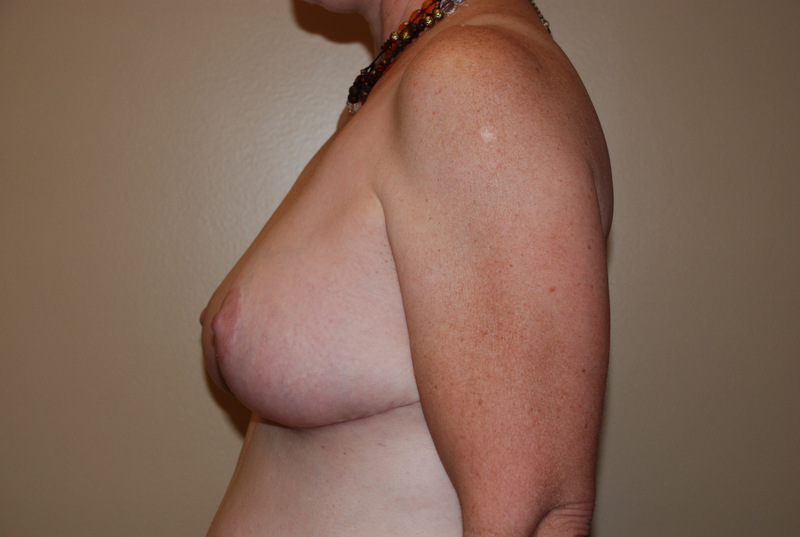 Breast-Reduction-08 | After Breast Reduction 5