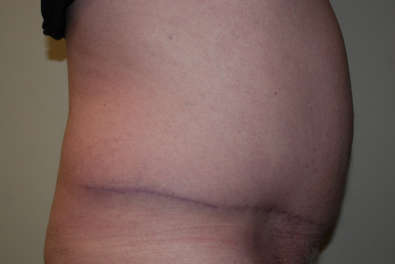 Tummy-Tuck-11 | After Tummy Tuck 5
