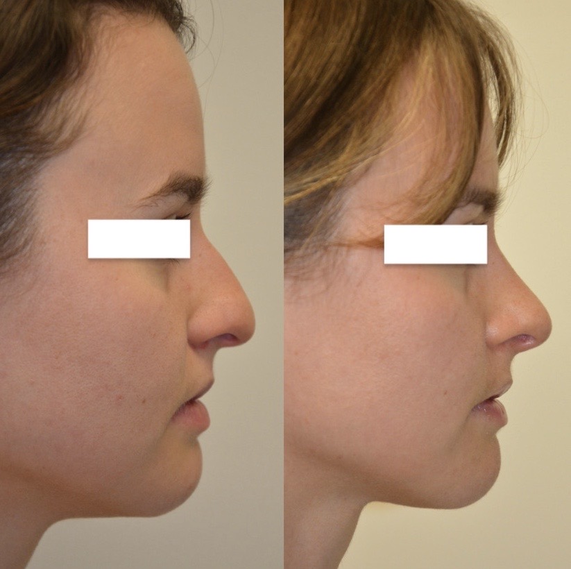 Rhinoplasty-07 | Before Rhinoplasty