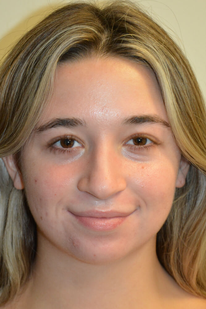 Rhinoplasty-09 | Before Rhinoplasty 5