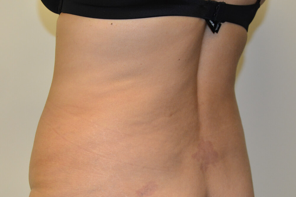 Liposuction-07 | Before Liposuction