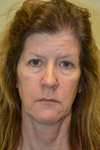 Eyelid-Surgery-10 | Before Eyelid Surgery 1
