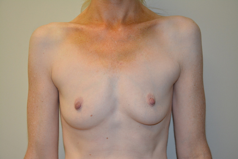 Breast-Augmentation-02 | Before Breast Augmentation