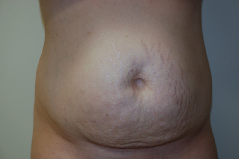 Tummy-Tuck-13 | Before Tummy Tuck