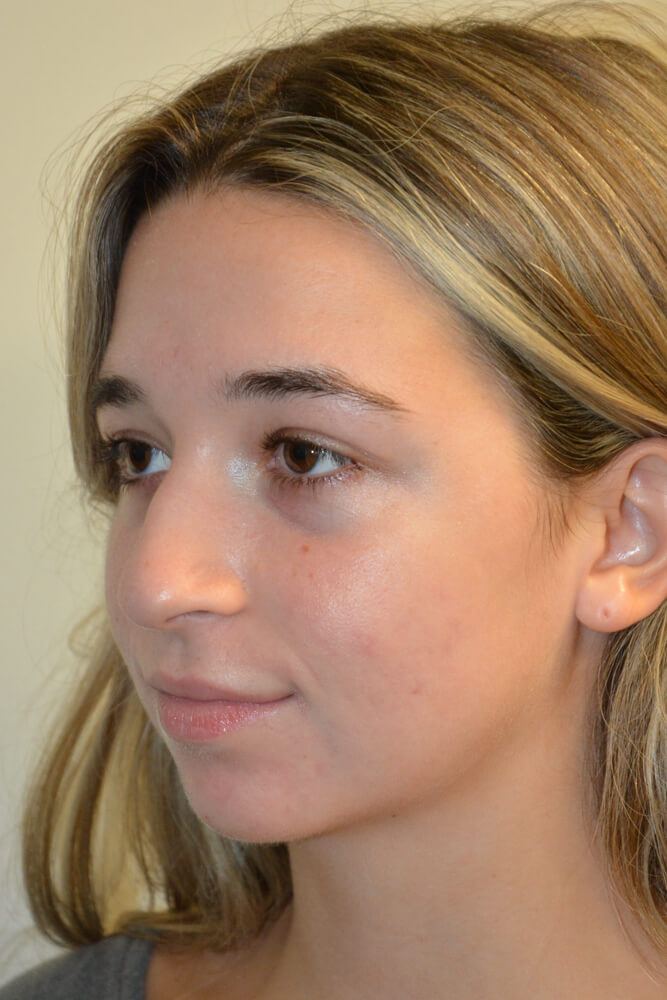Rhinoplasty-09 | Before Rhinoplasty 2