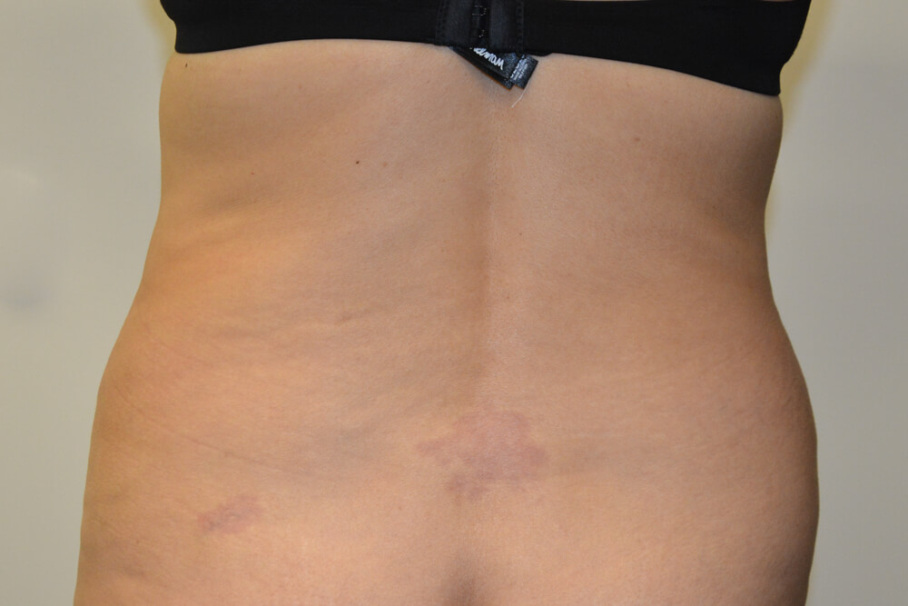 Liposuction-07 | Before Liposuction 2