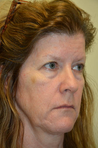 Eyelid-Surgery-10 | Before Eyelid Surgery 2
