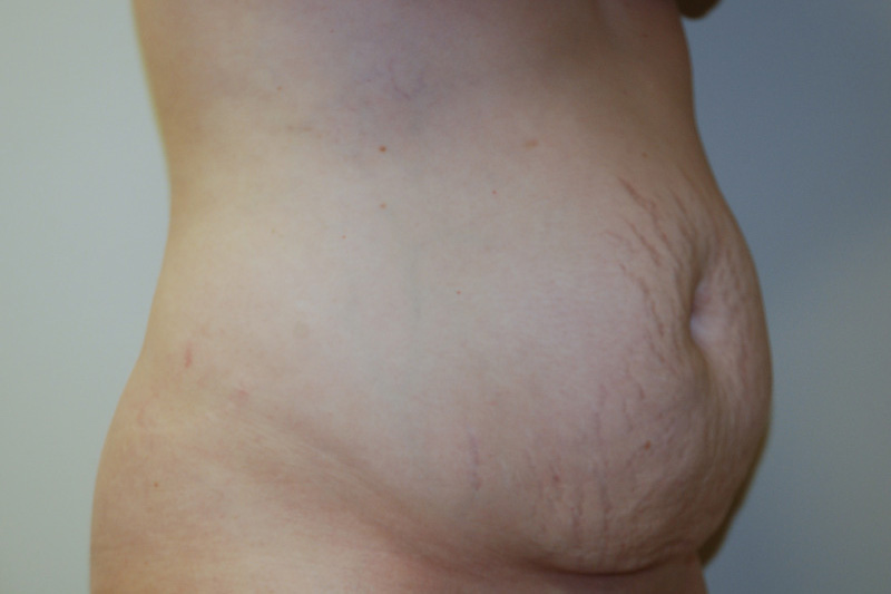 Tummy-Tuck-13 | Before Tummy Tuck 2