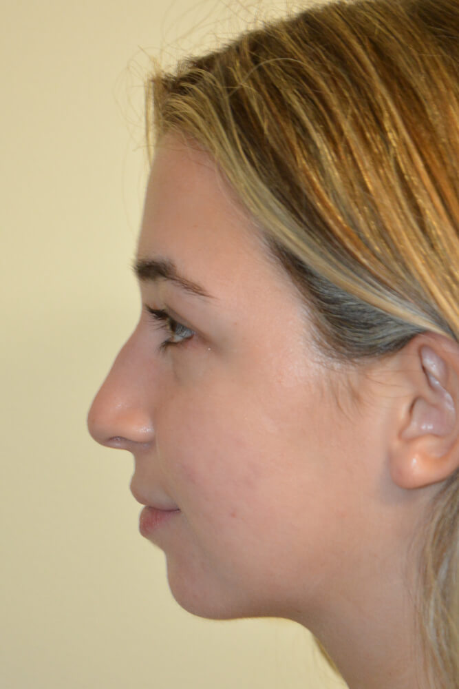 Rhinoplasty-09 | Before Rhinoplasty