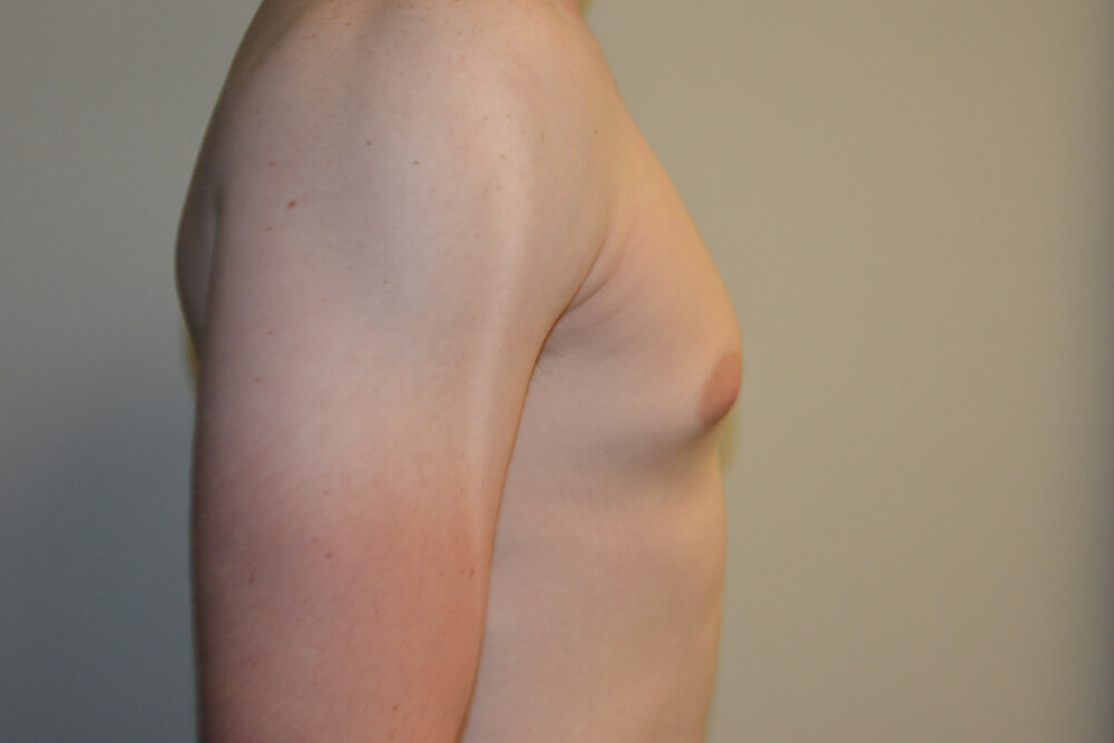 Male-Breast-Reduction-09 | Before Male Breast Reduction 3