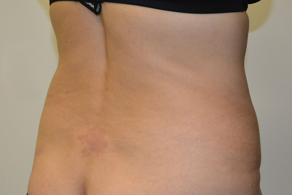 Liposuction-07 | Before Liposuction 3