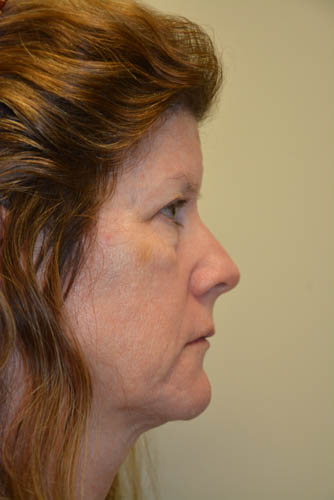 Eyelid-Surgery-10 | Before Eyelid Surgery 3