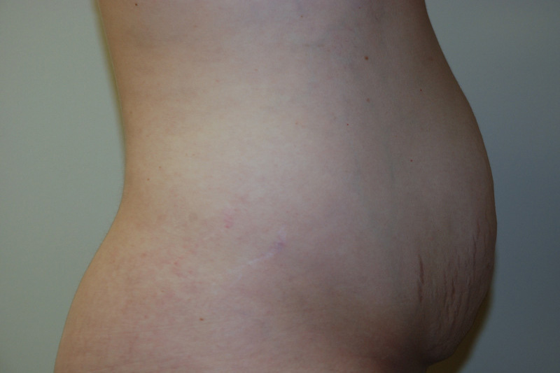 Tummy-Tuck-13 | Before Tummy Tuck 3