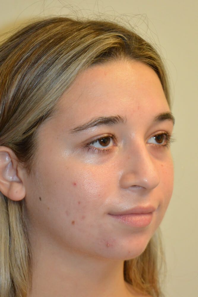 Rhinoplasty-09 | Before Rhinoplasty 4