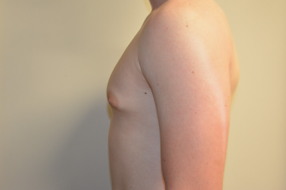 Male-Breast-Reduction-09 | Before Male Breast Reduction 5