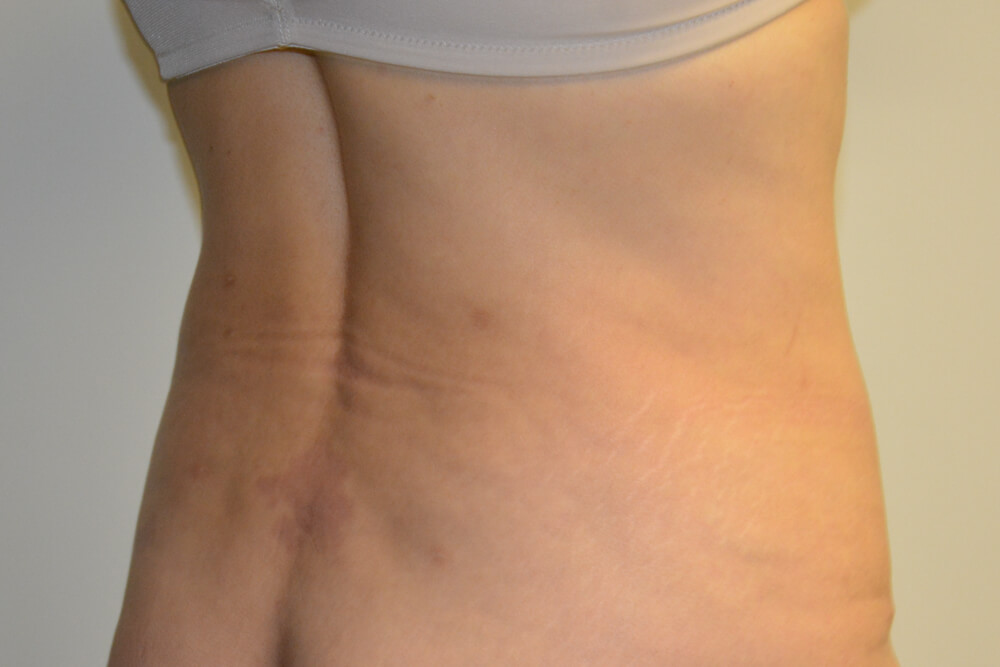 Liposuction-07 | After Liposuction 3