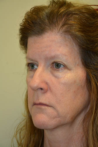Eyelid-Surgery-10 | Before Eyelid Surgery 4