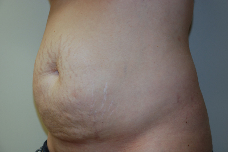 Tummy-Tuck-13 | Before Tummy Tuck 4