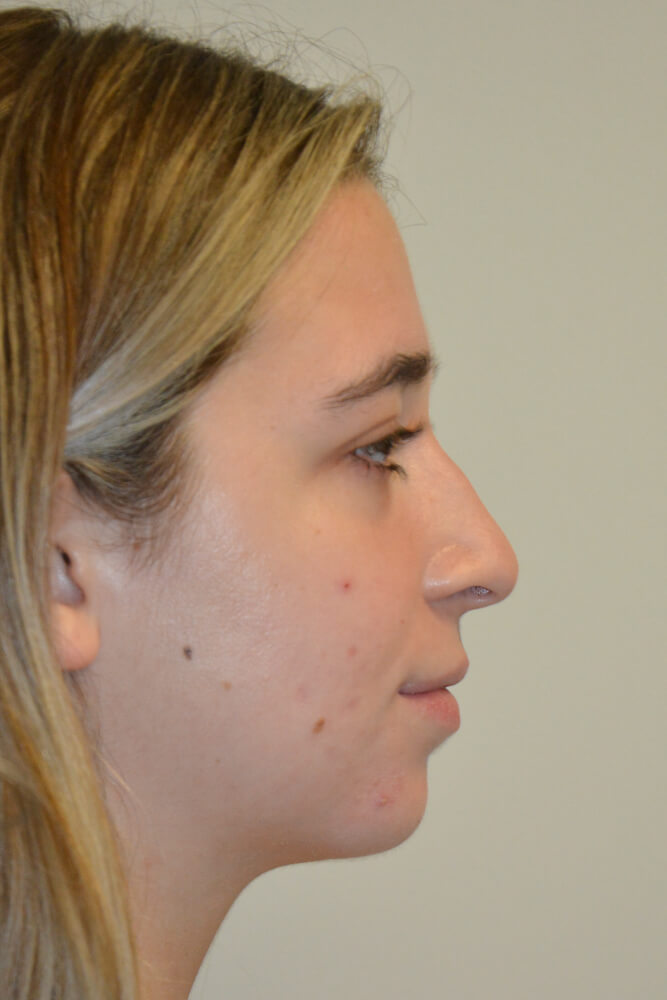 Rhinoplasty-09 | Before Rhinoplasty 3