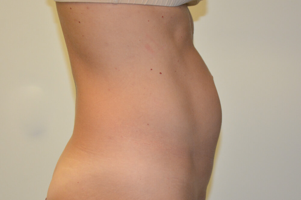 Mini-Tummy-Tuck-09 | Before Mini Tummy Tuck 3